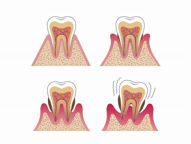 歯周病
